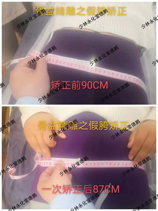 少林永化堂產(chǎn)后項目-骨盆修復(fù)1.jpg
